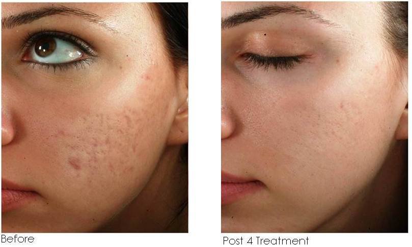Statera Meso Skin Therapy Microneedle